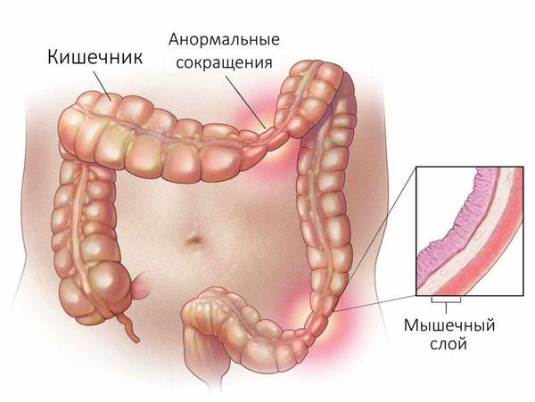 синдром раздраженного кишечника