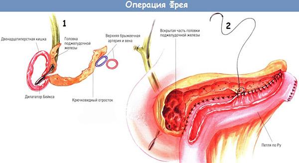 операция фрея