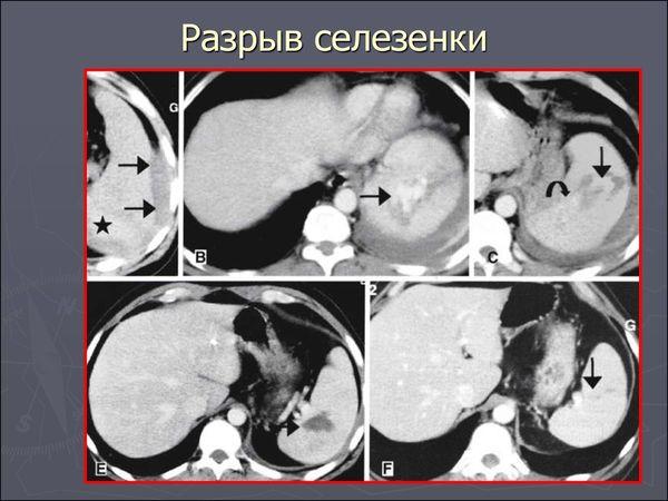 разрыв селезенки