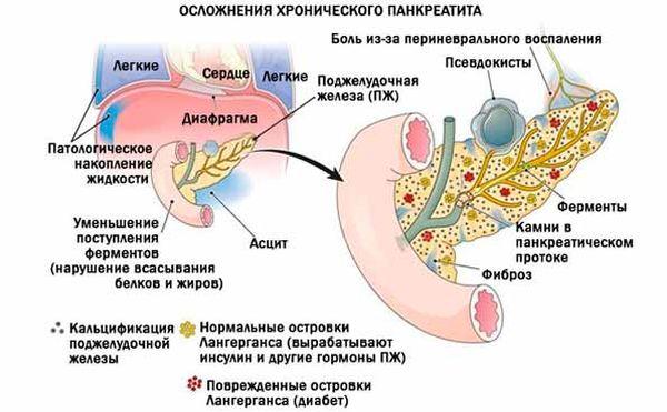 осложнения панкреатита