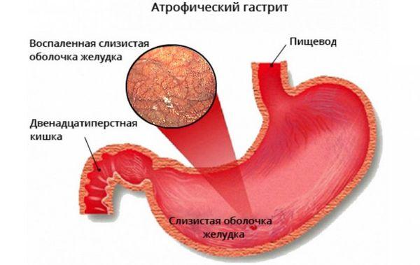атрофический гастрит