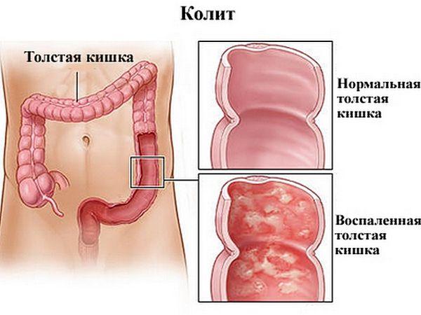 колит