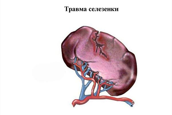 травма селезенки