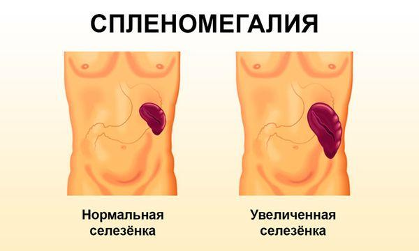спленомегалия