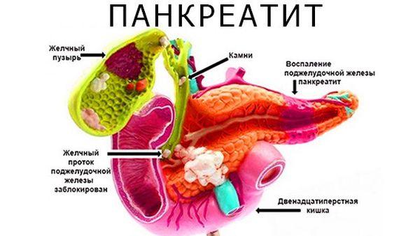 панкреатит
