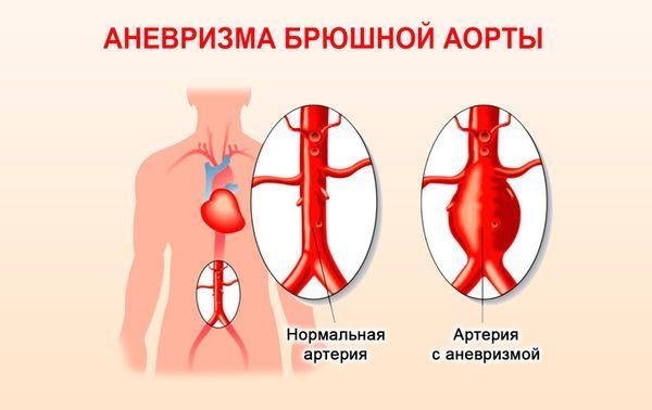 аневризма аорты