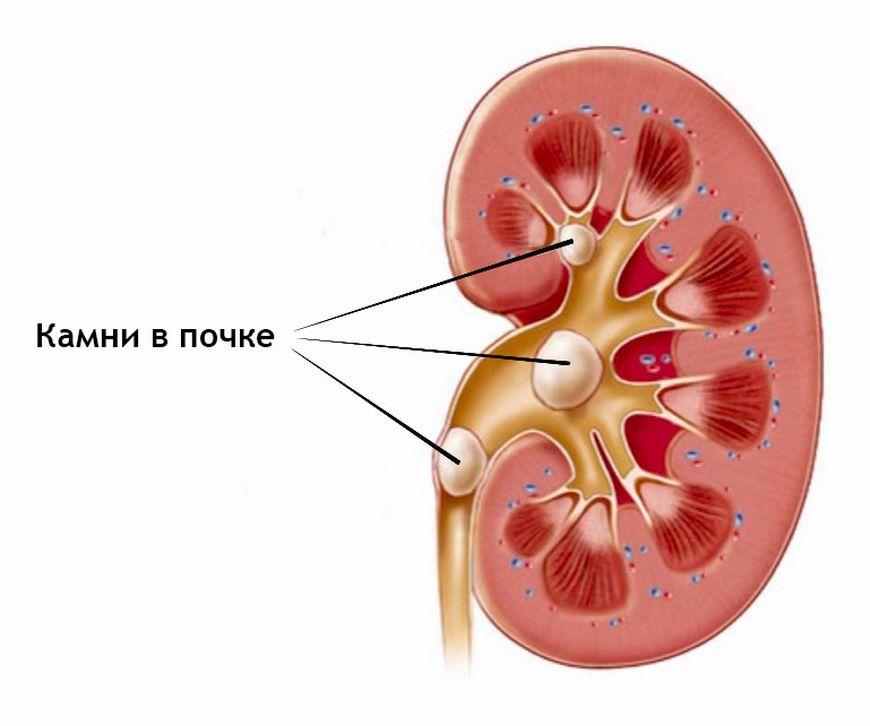 камни в почке