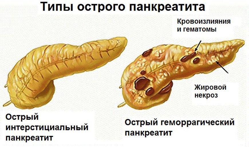 острый панреатит