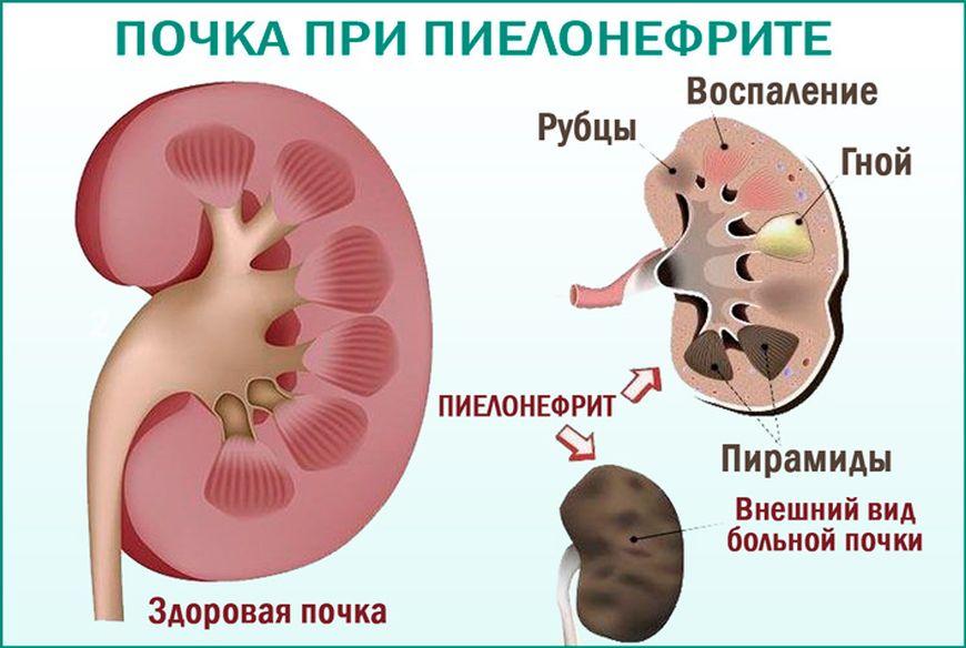 пиелонефрит 