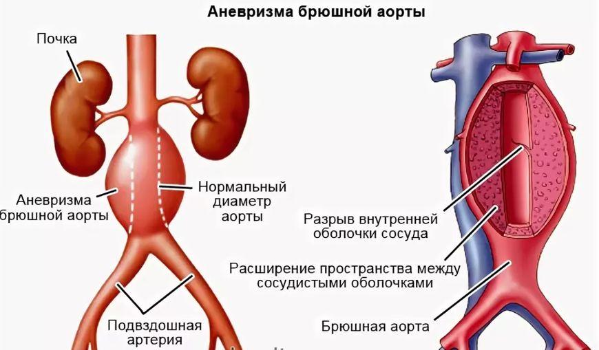 аневризма 