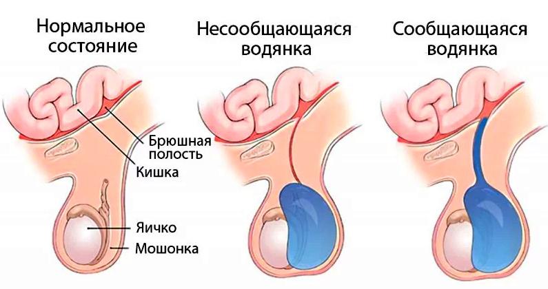 Водянка яичка лечение 