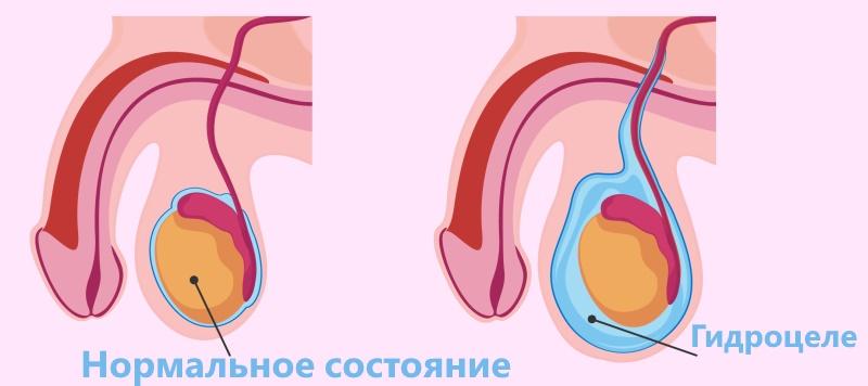 Водянка (гидроцеле) симптомы