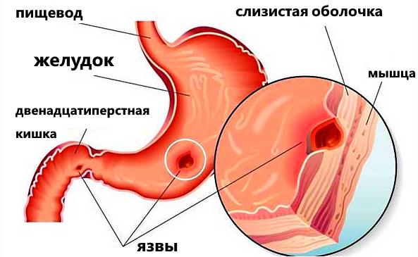 язва желудка лечение