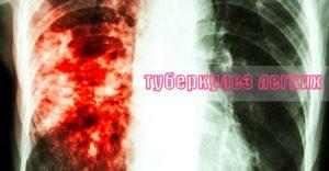 туберкулез легких