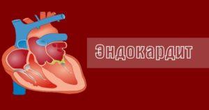 эндокардит