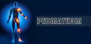 ревматизм
