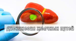 Дискинезия желчных путей