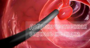 Доброкачественная опухоль желудка