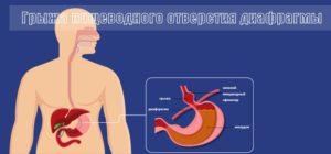Грыжа пищеводного отверстия диафрагмы