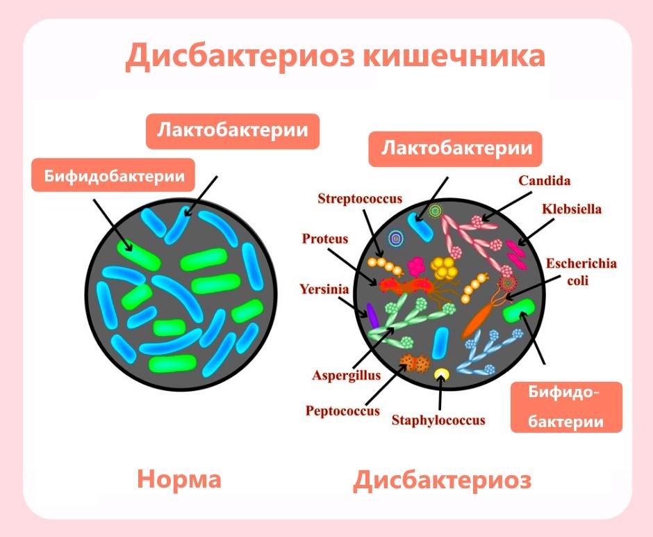 дисбактериоз кишечника