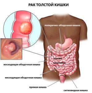 рак толстой кишки