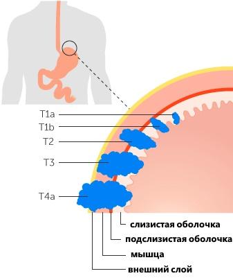 стадии рака желудка