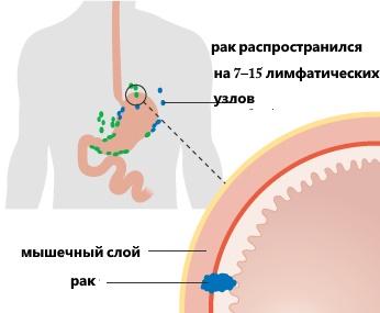 Рак в стадии 3А
