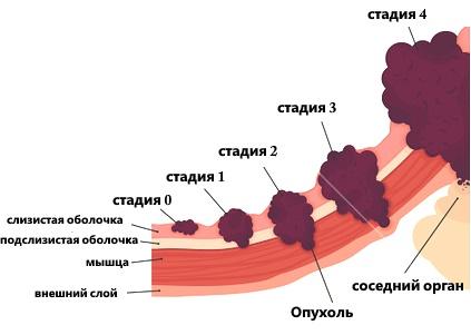 стадии рака желудка
