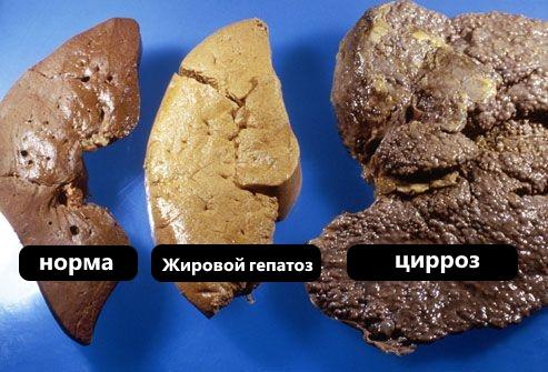 как выглядит цирроз печени
