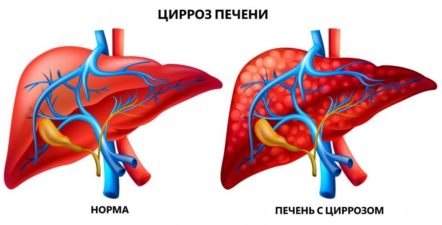 цирроз печени клиническая картина