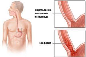 Эзофагит