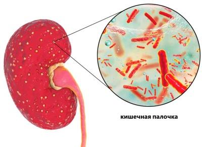 Острый пиелонефрит