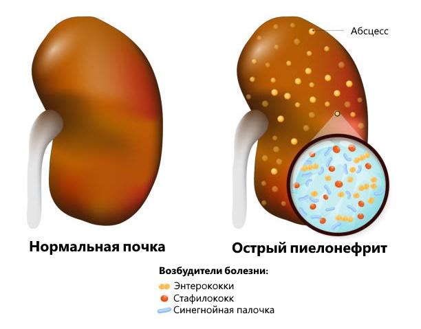 Острый пиелонефрит