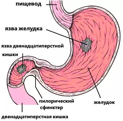 Язвенная болезнь желудка и двенадцатиперстной кишки