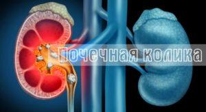 почечная колика