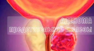 Аденома предстательной железы