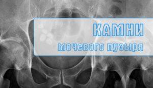 Камни мочевого пузыря
