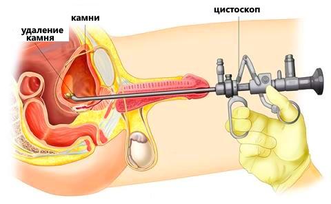 Литопаксия