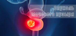 Опухоль мочевого пузыря