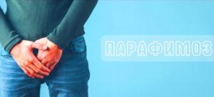 парафимоз это