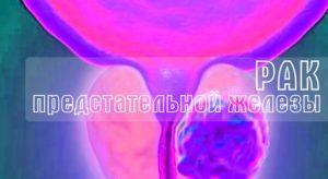 рак предстательной железы