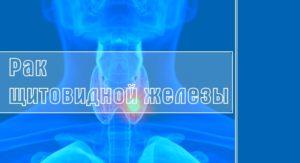 рак щитовидки симптомы