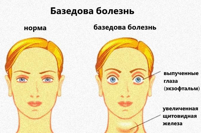 симптомы базедовой болезни