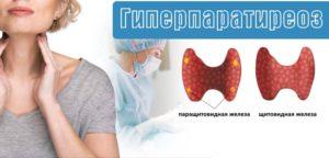 uиперпаратиреоз