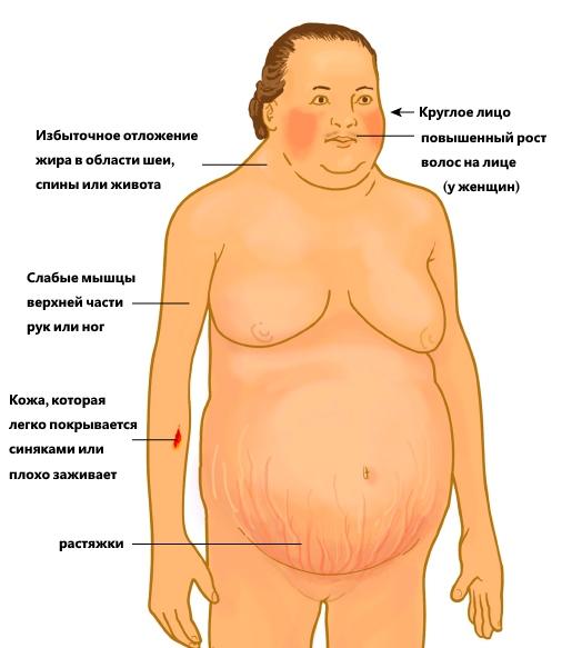 болезнь иценко кушинга симптомы