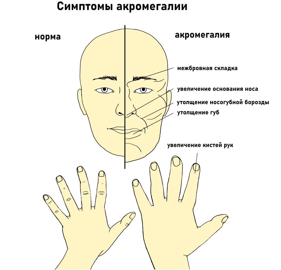 акромегалия симптомы